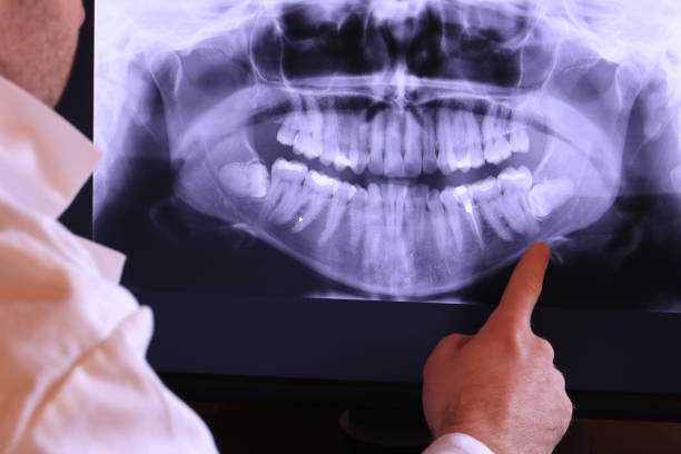 Best Emergency Wisdom Tooth Extraction in Muniz, TX