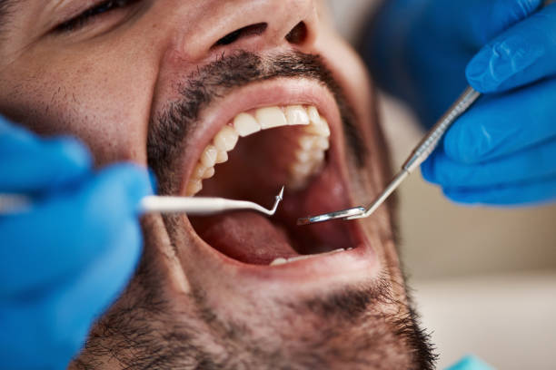 Best Dental Abscess Treatment in Muniz, TX